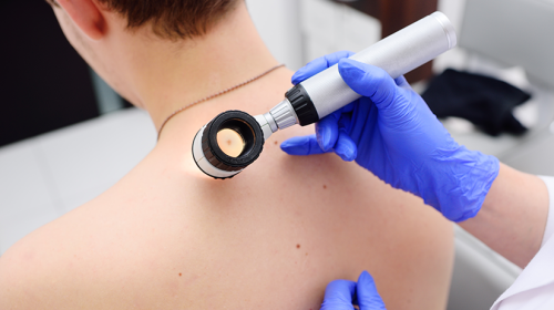 Vaccin testat cu succes împotriva cancerului de piele. Când ar putea ajunge în România